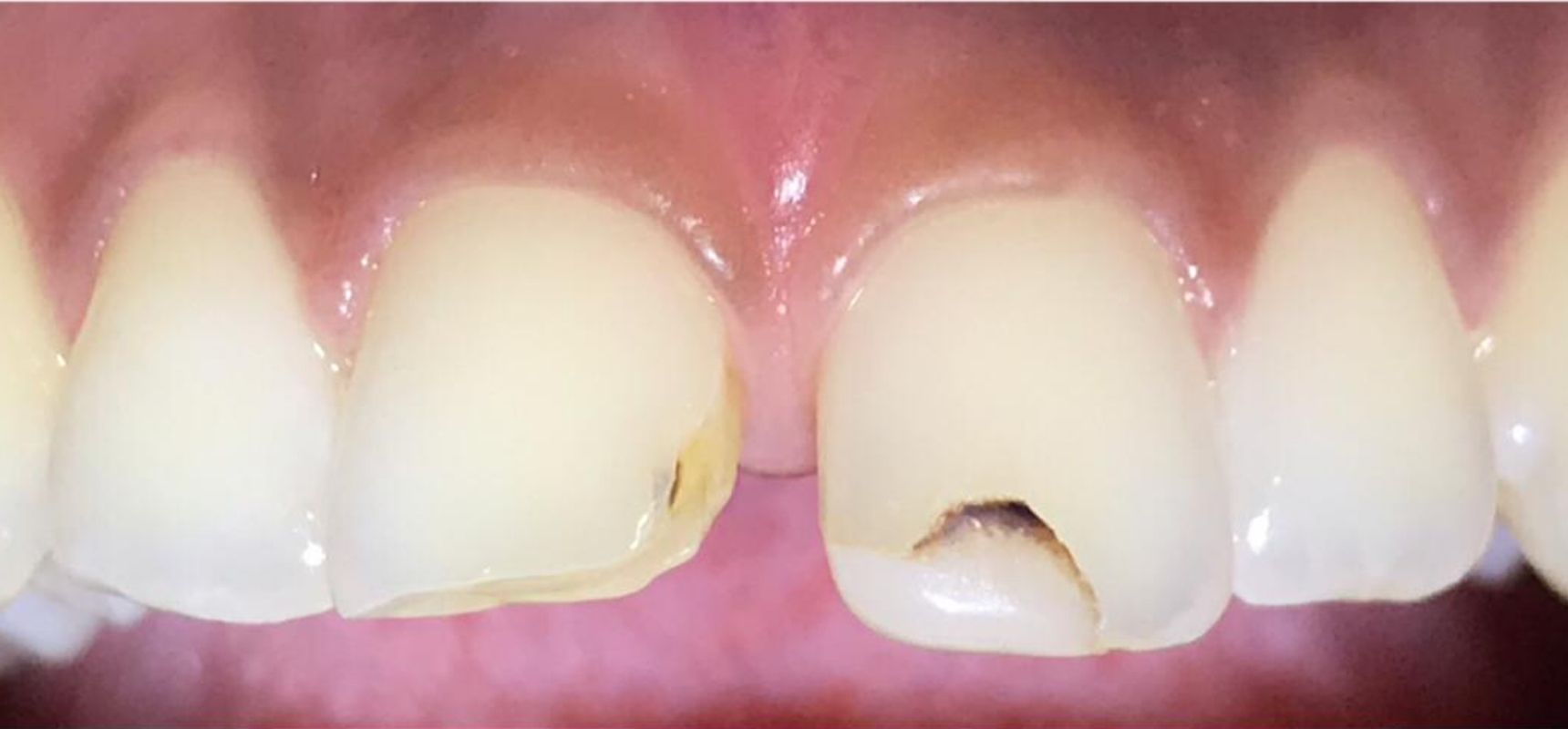 Before-Composite filling to close midline diastema and teeth length adjustment