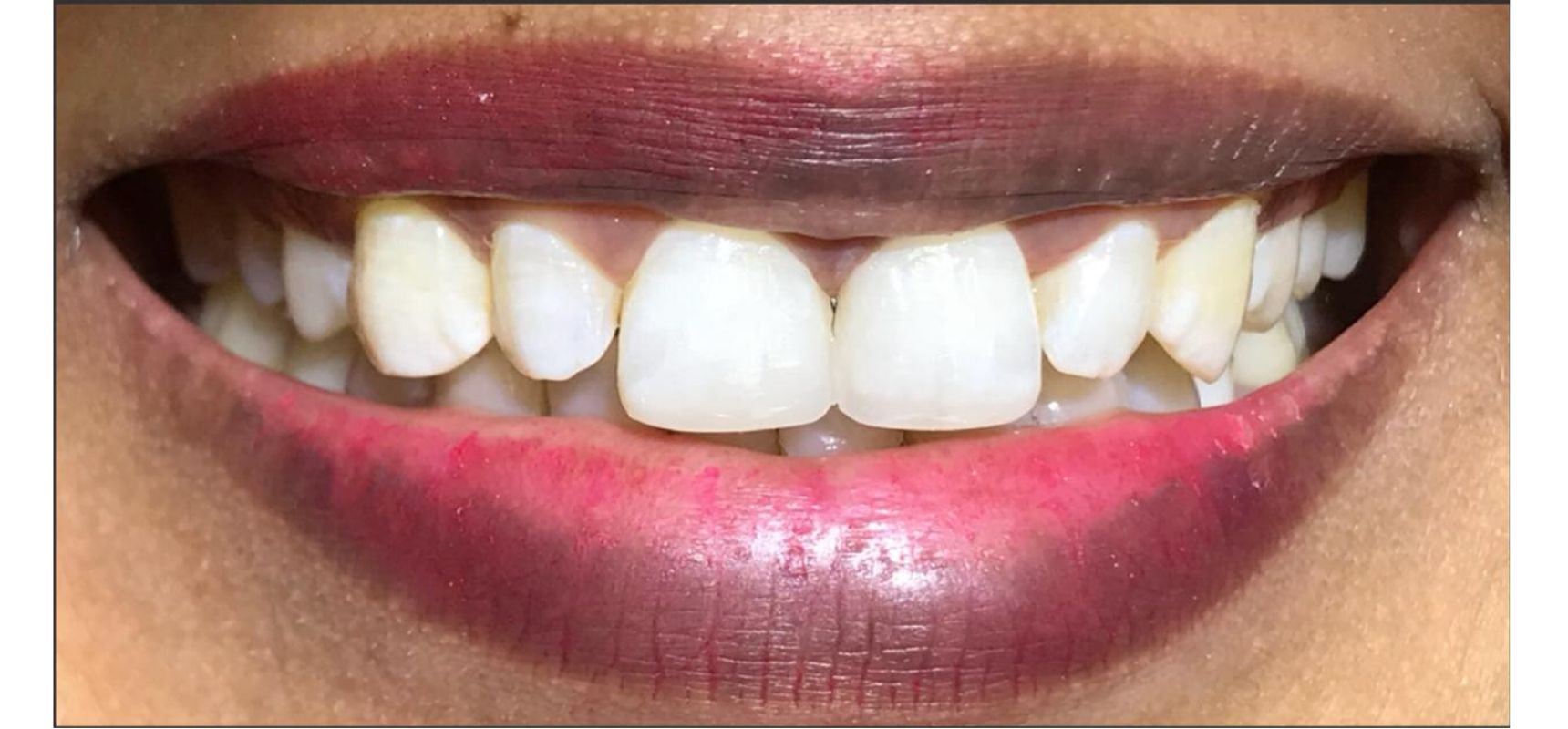 After-Composite filling to close midline diastema and teeth length adjustment