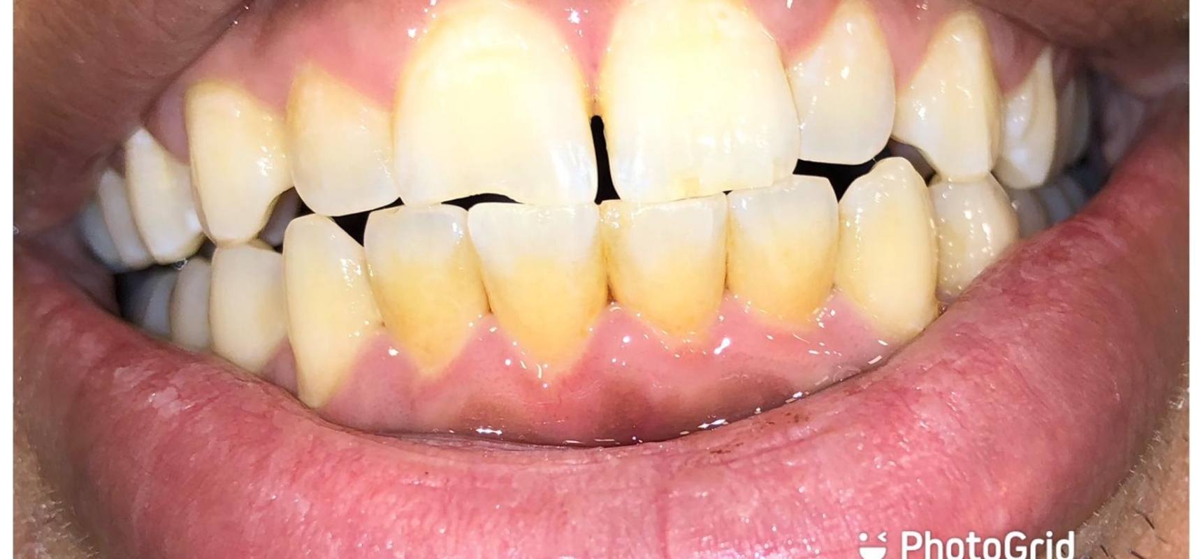 After-Full mouth scaling and polishing