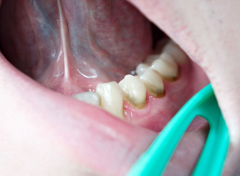 Gum & Periodontal Dentistry - Dr Sadiq Sharaf Dental Center