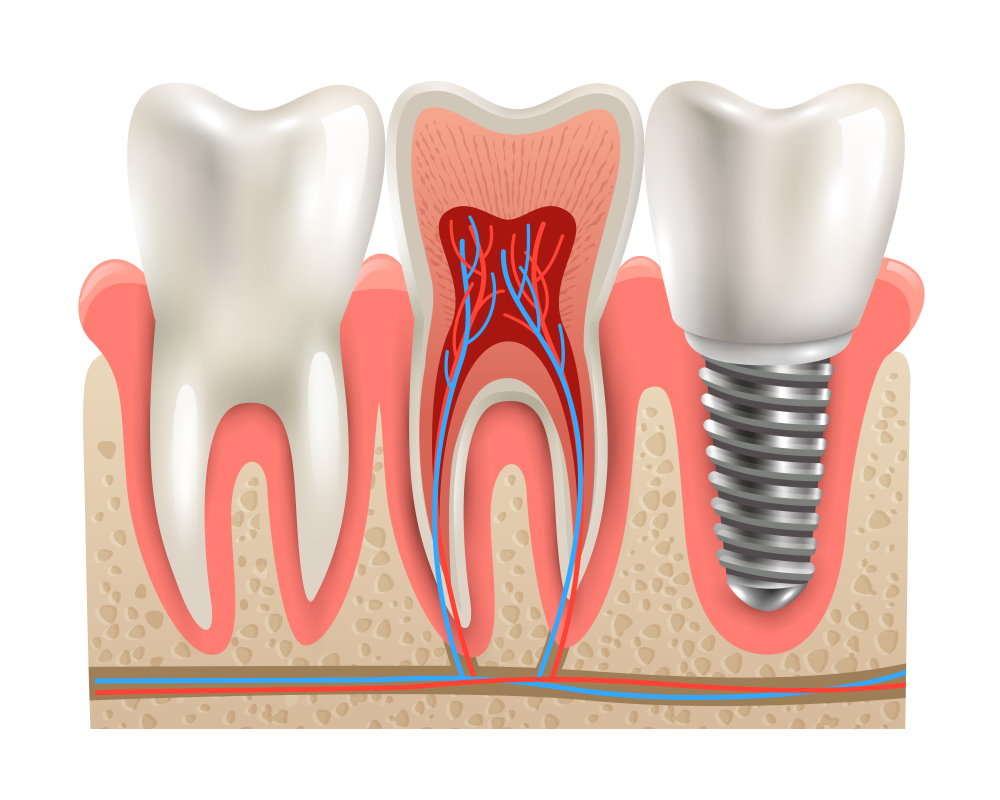 Dental implant - Dr Sadiq Sharaf Dental Center
