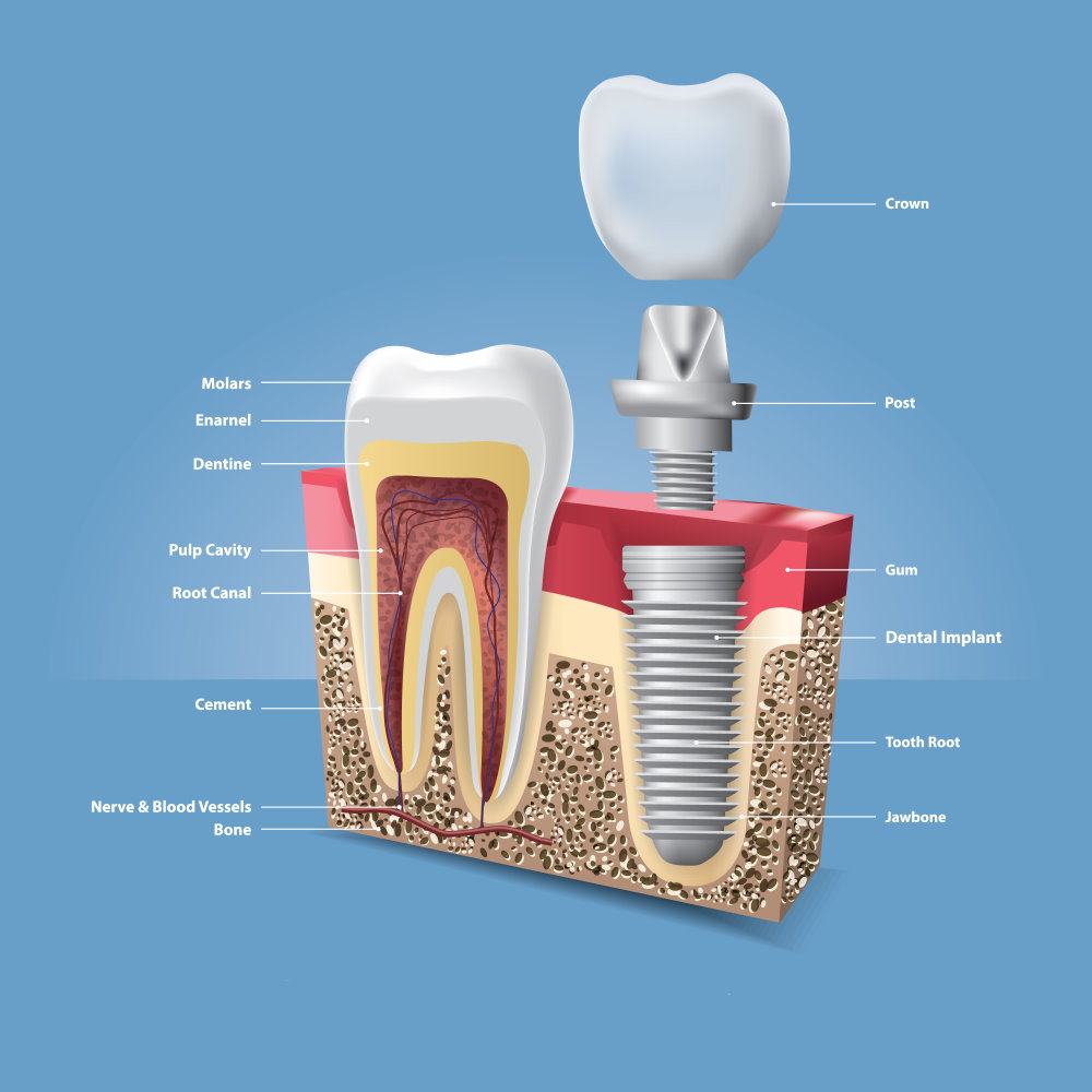 Dental implant - Dr Sadiq Sharaf Dental Center