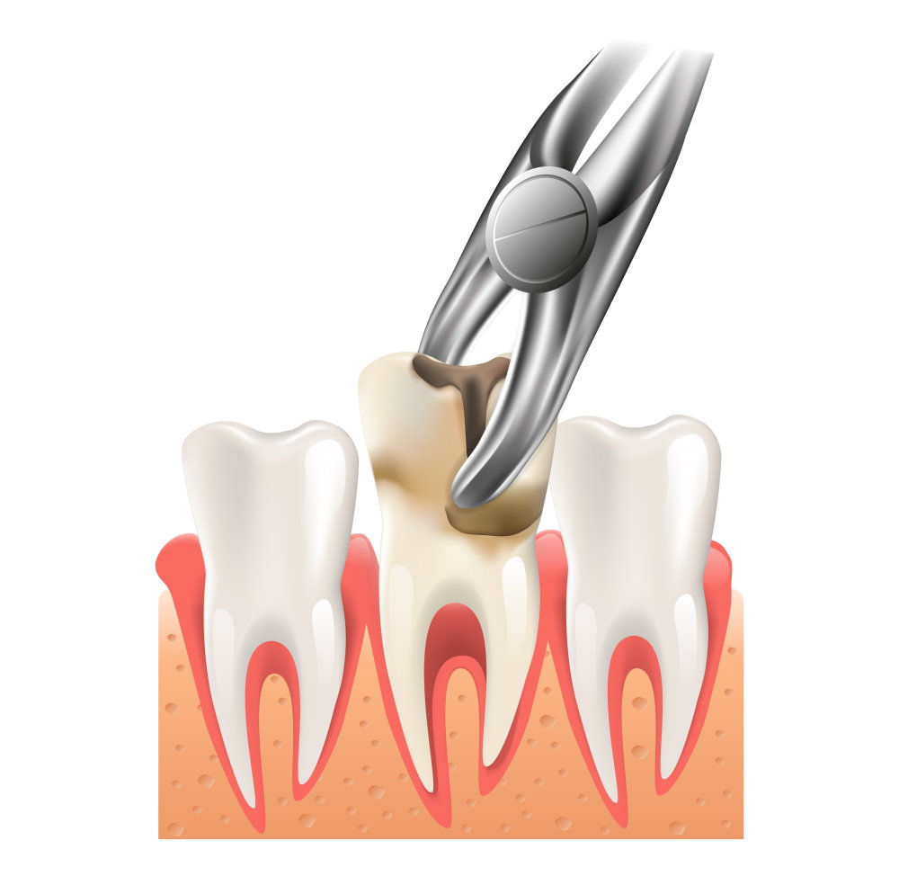Tooth Extraction  - Dr Sadiq Sharaf Dental Center