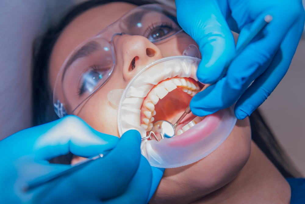 Dental Fillings - Dr Sadiq Sharaf Dental Center