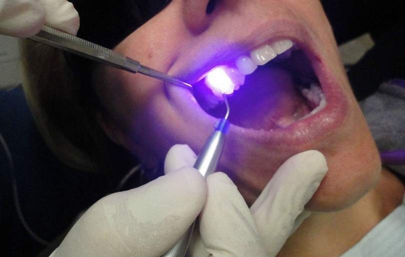 Laser Dentistry - Dr Sadiaq Sharaf Dental Center