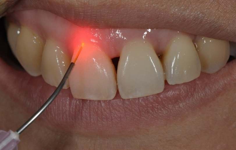 Laser Dentistry - Dr Sadiaq Sharaf Dental Center