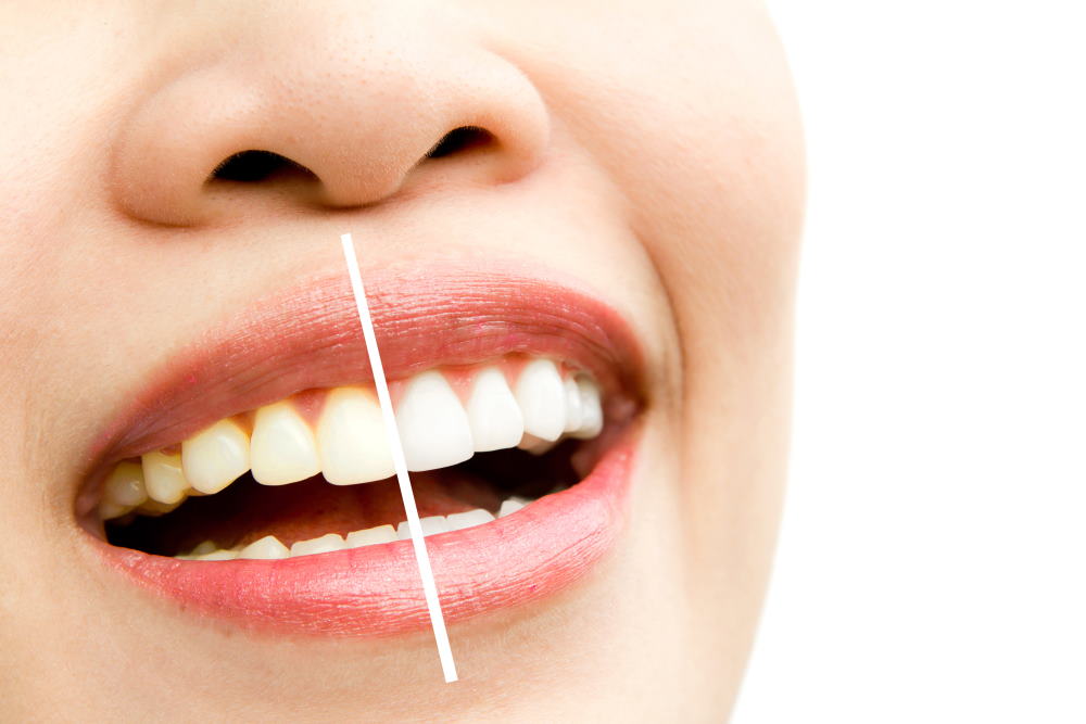 Teeth Whitening - Dr Sadiq SHaraf Dental Center